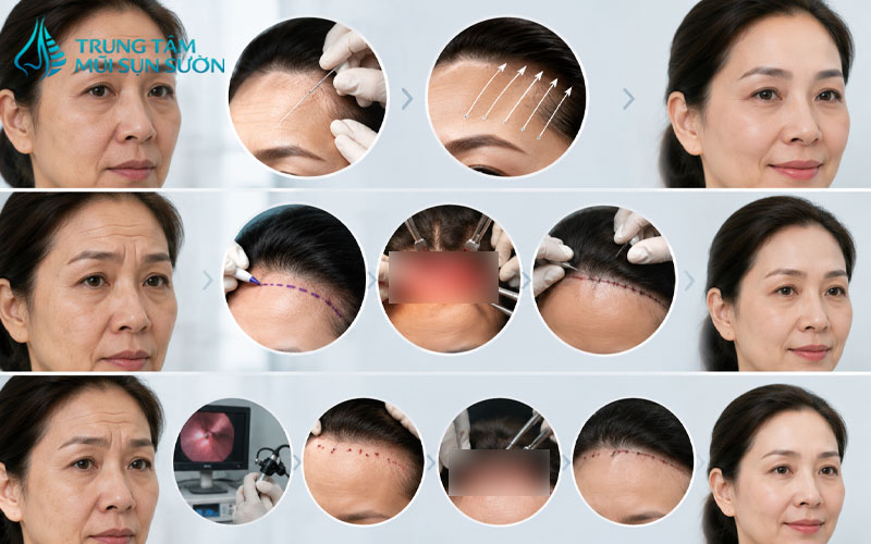 cac-phuong-phap-cang-da-tran-pho-bien-nhat-hien-nay