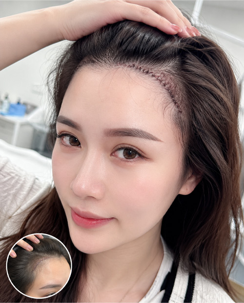 Cắt lọc - khâu vết thương da đầu mang tóc