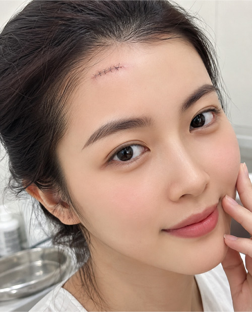 Cắt lọc - khâu vết thương vùng trán