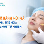 Cấy mỡ rãnh mũi má