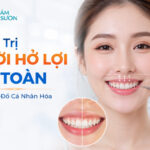 Điều trị cười hở lợi
