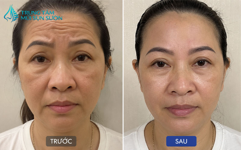 hinh-anh-truoc-va-sau-khi-cang-da-tran-2