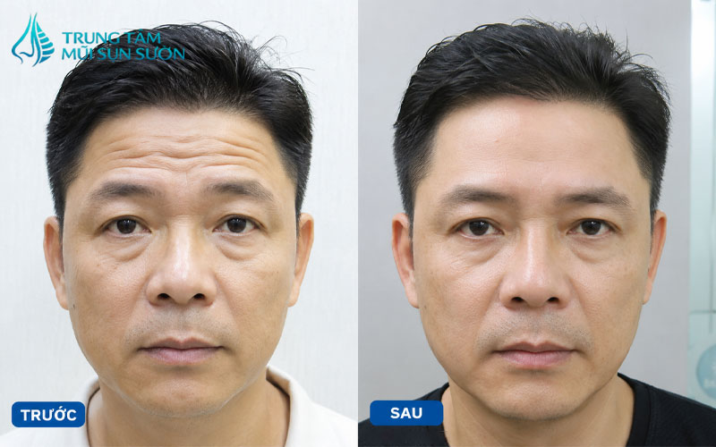 hinh-anh-truoc-va-sau-khi-cang-da-tran-3