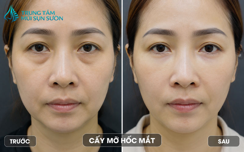 hinh-anh-truoc-va-sau-khi-cay-mo-hoc-mat-2