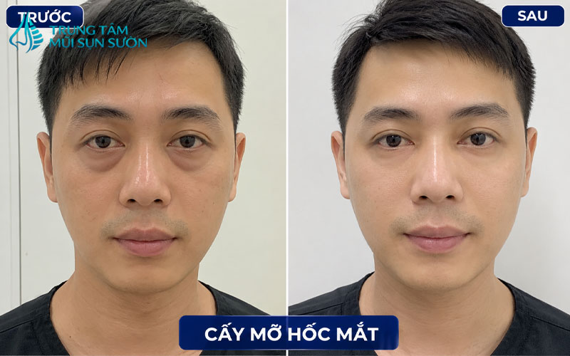 hinh-anh-truoc-va-sau-khi-cay-mo-hoc-mat-3