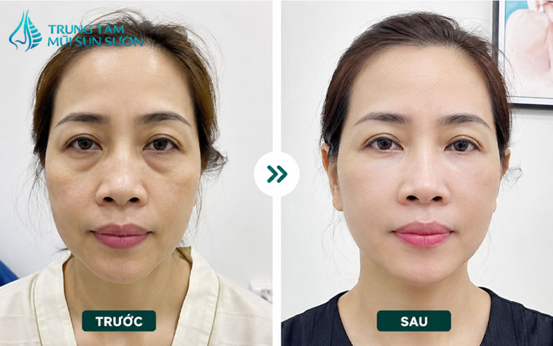 hinh-anh-truoc-va-sau-khi-cay-mo-hoc-mat