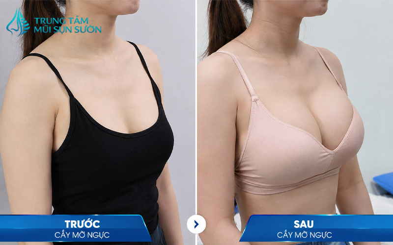 hinh-anh-truoc-va-sau-khi-cay-mo-nguc