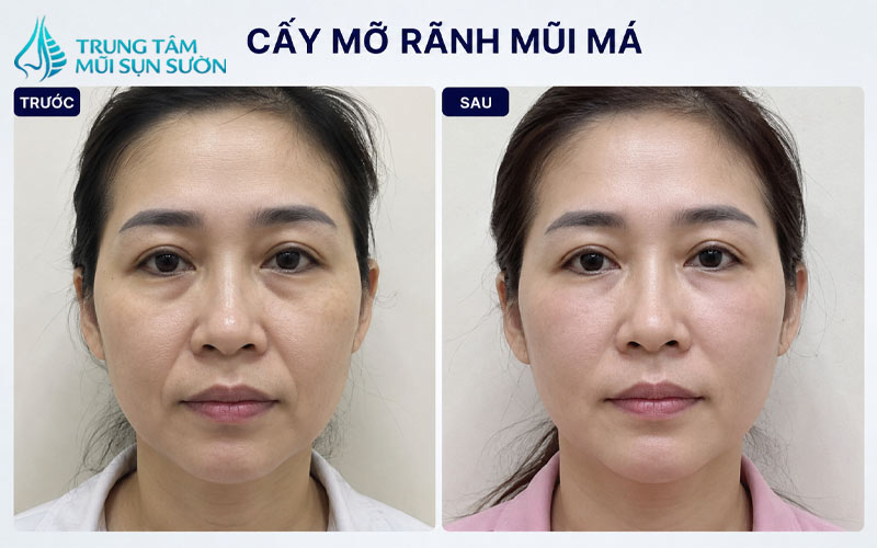 hinh-anh-truoc-va-sau-khi-cay-mo-ranh-mui-ma-2