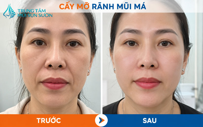 hinh-anh-truoc-va-sau-khi-cay-mo-ranh-mui-ma-4