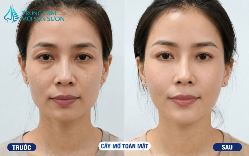 hinh-anh-truoc-va-sau-khi-cay-mo-toan-mat-3