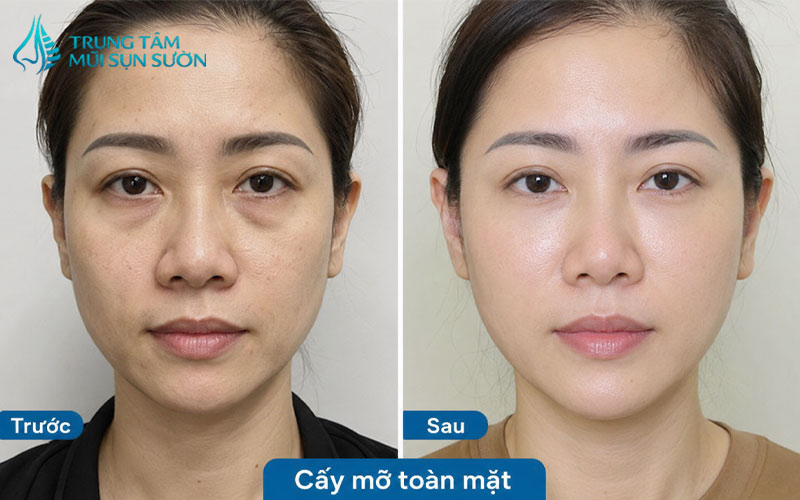 hinh-anh-truoc-va-sau-khi-cay-mo-toan-mat