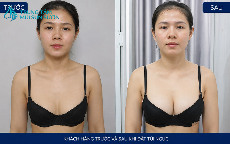 hinh-anh-truoc-va-sau-khi-dat-tui-nguc-1