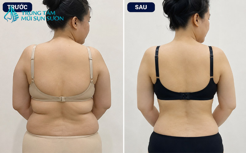 hinh-anh-truoc-va-sau-khi-hut-mo-lung-2