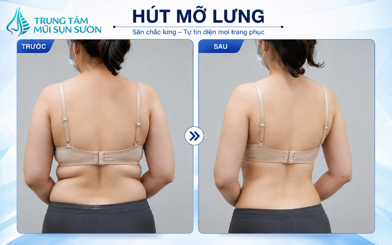 hinh-anh-truoc-va-sau-khi-hut-mo-lung
