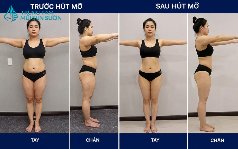 hinh-anh-truoc-va-sau-khi-hut-mo-tay-chan-2
