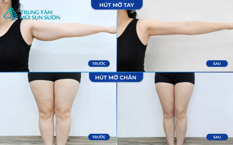 hinh-anh-truoc-va-sau-khi-hut-mo-tay-chan