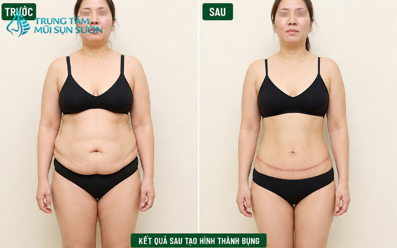 hinh-anh-truoc-va-sau-khi-tao-hinh-thanh-bung-2