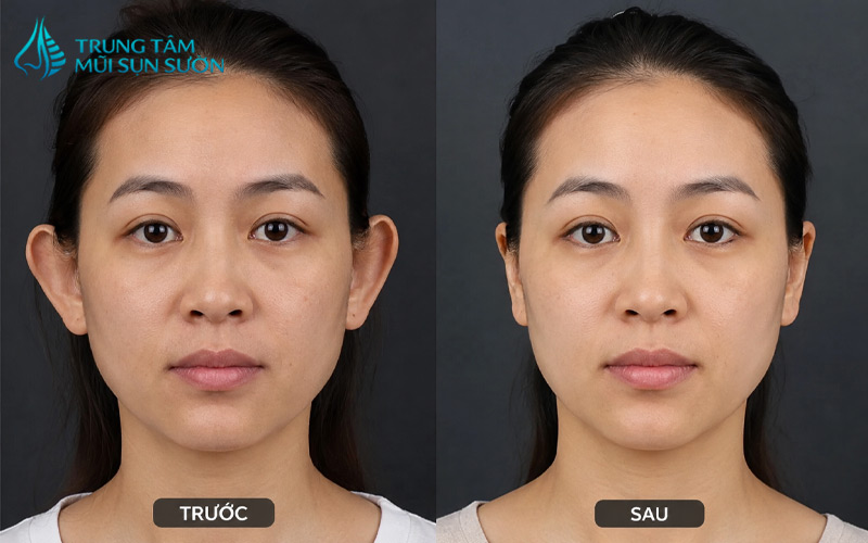 hinh-anh-truoc-va-sau-khi-thu-nho-vanh-tai-2