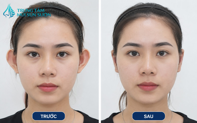 hinh-anh-truoc-va-sau-khi-thu-nho-vanh-tai