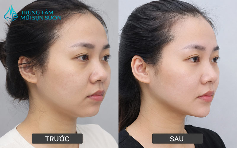 hinh-anh-truoc-va-sau-khi-thuc-hien-don-cam-v-line-2