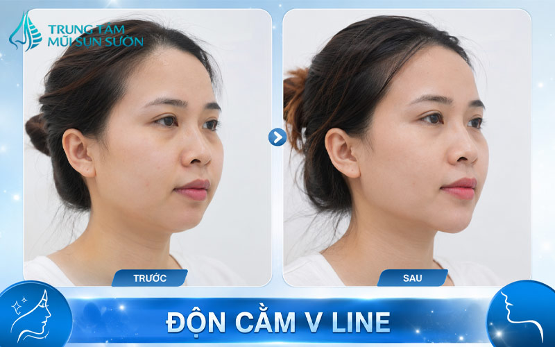 hinh-anh-truoc-va-sau-khi-thuc-hien-don-cam-v-line