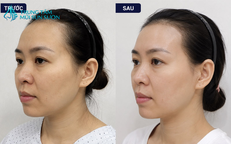 hinh-anh-truoc-va-sau-khi-thuc-hien-don-thai-duong-2