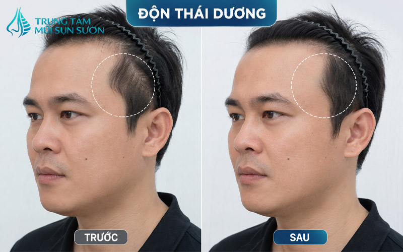 hinh-anh-truoc-va-sau-khi-thuc-hien-don-thai-duong-3