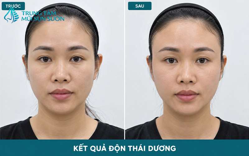 hinh-anh-truoc-va-sau-khi-thuc-hien-don-thai-duong