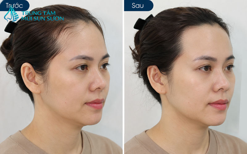 hinh-anh-truoc-va-sau-khi-thuc-hien-don-tran-2