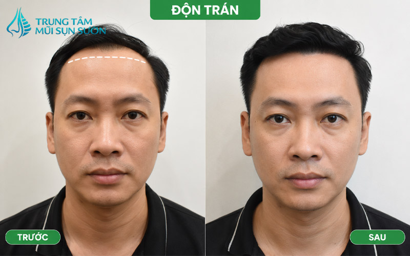 hinh-anh-truoc-va-sau-khi-thuc-hien-don-tran-3