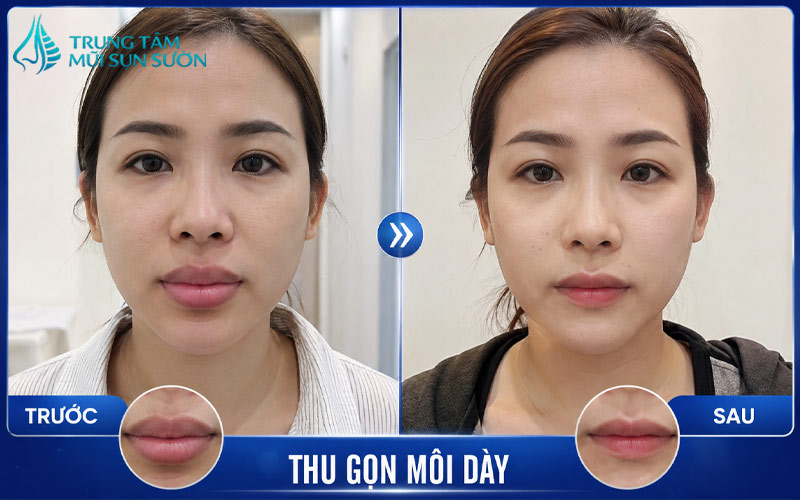 hinh-anh-truoc-va-sau-khi-thuc-hien-thu-gon-moi-day-1