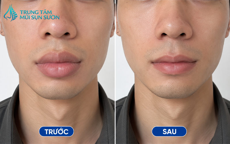 hinh-anh-truoc-va-sau-khi-thuc-hien-thu-gon-moi-day-3