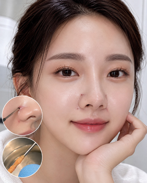 Hút mỡ vùng nếp mũi má, má