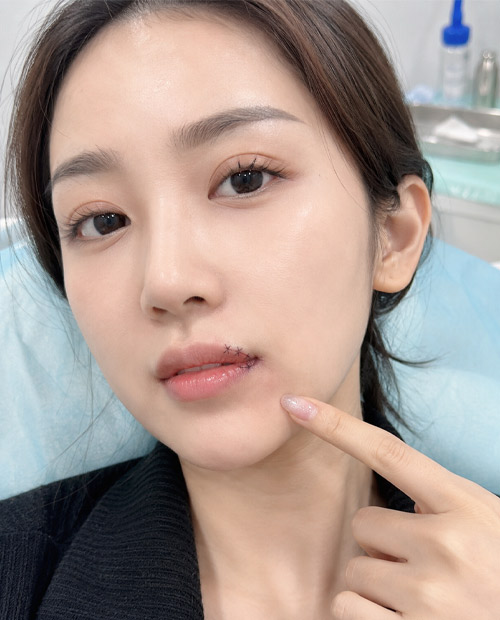 Khâu vết thương vùng môi