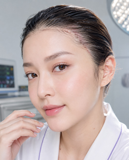 Phẫu thuật căng da trán thái dương