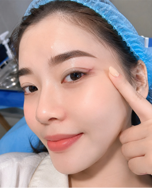 Phẫu thuật cắt bỏ khối u da lành tính mi mắt