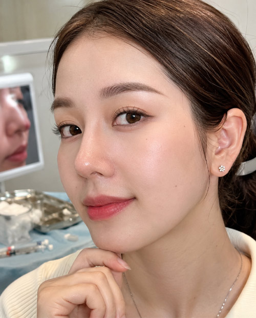 Phẫu thuật chỉnh sửa các biến chứng sau chích chất làm đầy vùng mũi