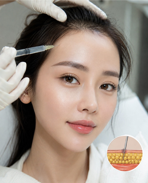 Phẫu thuật ghép mỡ trung bì vùng trán