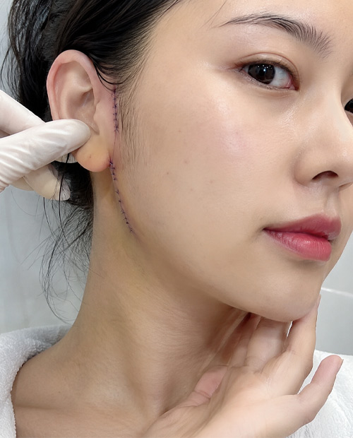 Phẫu thuật khâu đơn giản vết thương vùng mặt cổ