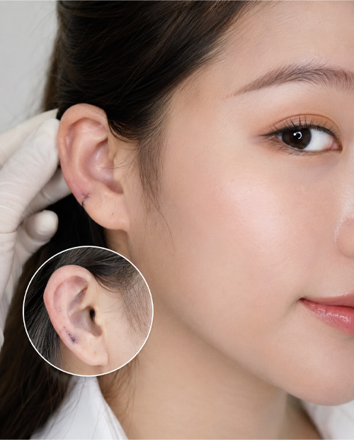 Phẫu thuật khâu vết rách đơn giản vành tai