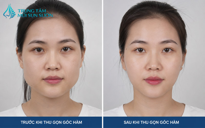 truoc-va-sau-khi-thuc-hien-thu-gon-goc-ham-2