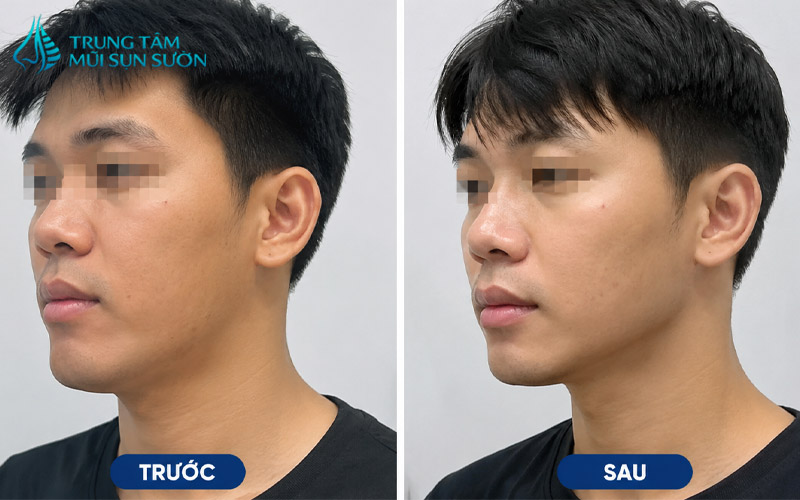 truoc-va-sau-khi-thuc-hien-thu-gon-goc-ham-3