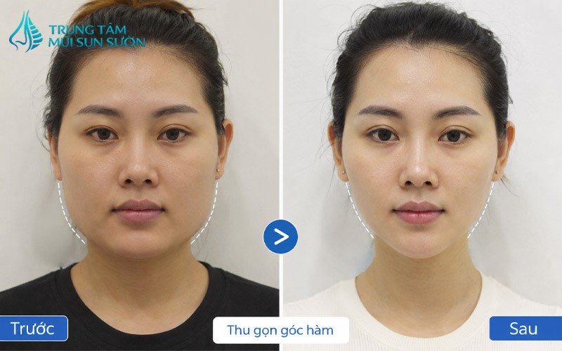 truoc-va-sau-khi-thuc-hien-thu-gon-goc-ham