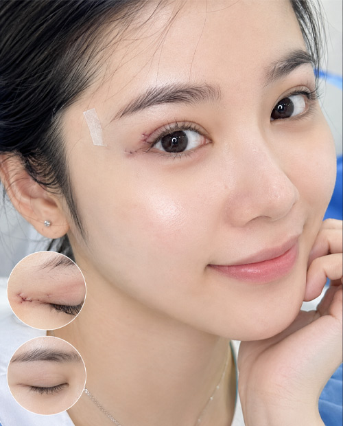 Xử lý vết thương phần mềm nông vùng mi mắt