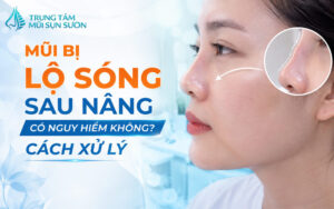 Mũi bị lộ sóng sau nâng có nguy hiểm không? Cách xử lý