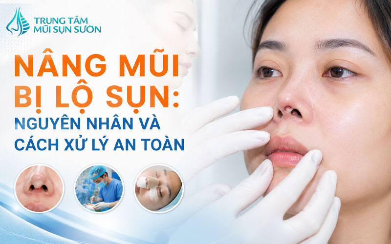 nang-mui-bi-lo-sun