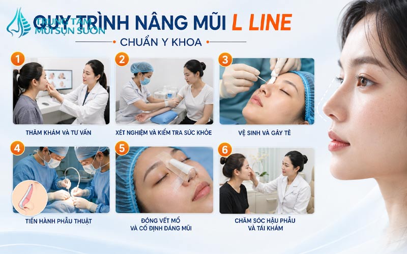 quy-trinh-nang-mui-l-line-chuan-y-khoa