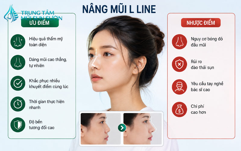uu-nhuoc-diem-cua-phuong-phap-nang-mui-l-line